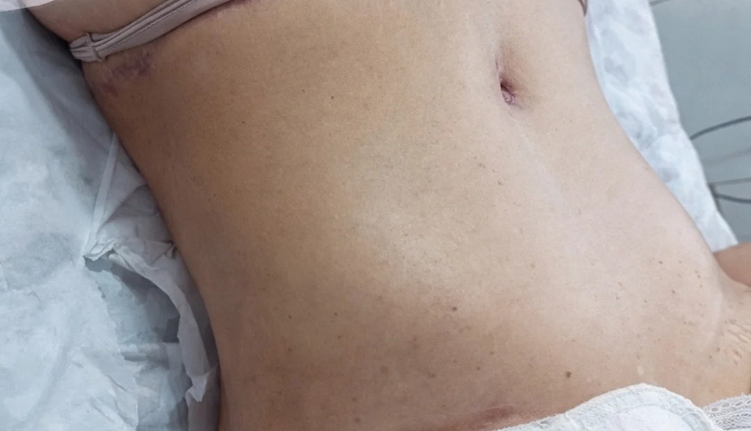 Pós-operatório 3 meses depois