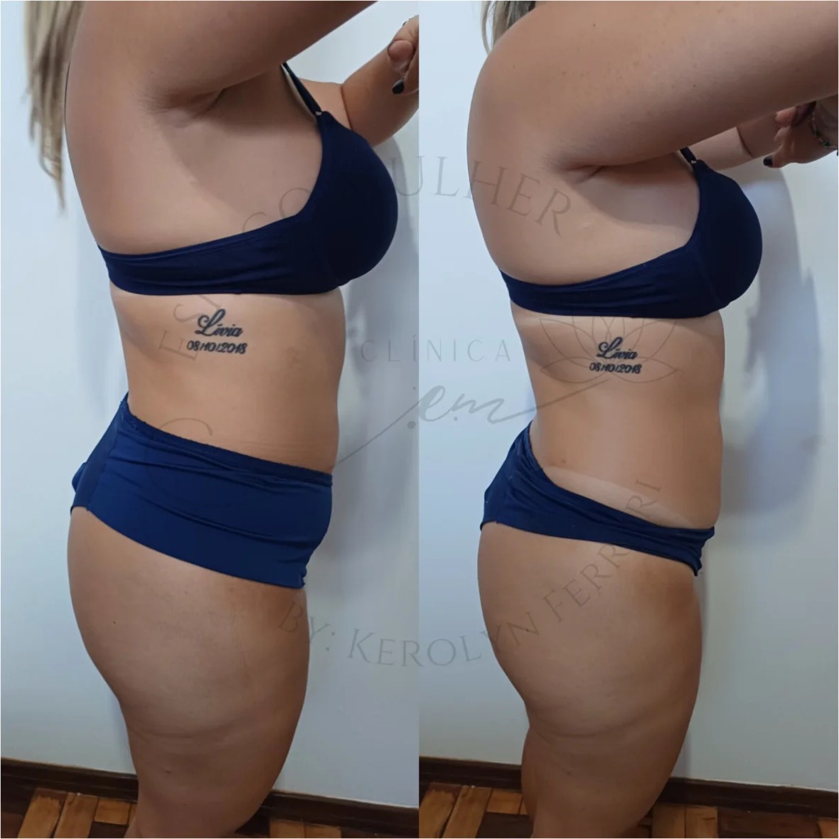Antes e depois de drenagem